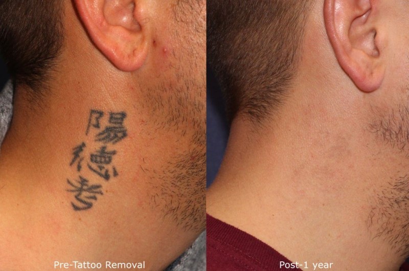 Tattoo Removal Before and After